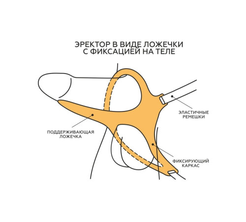 Эректор с фиксацией